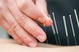 Needles for Well-being: What is Acupuncture?
