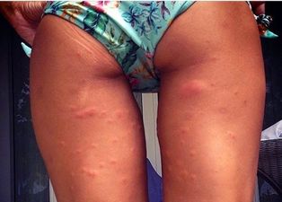 And We Thought She Had Class… Celebrity Shares Photo Of Her Mosquito-Bitten Backside