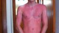 PHOTO: OUCH! The Photo Definition Of Why You Should Wear Sunscreen