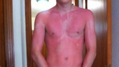 PHOTO: OUCH! The Photo Definition Of Why You Should Wear Sunscreen