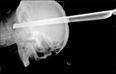 Bizarre X-Ray: Man Survives Metal Stool Leg Through His Head After Bar Brawl