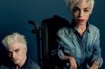Young Fashion Blogger With Muscular Dystrophy Becomes A Model For Diesel