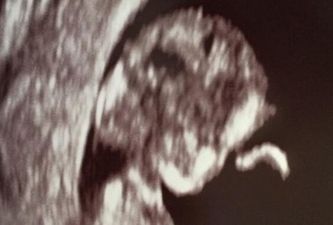 Model Reveals Pregnancy With Sonogram Snap on Twitter