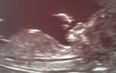 Soap Star Reveals Pregnancy With Sonogram Snap