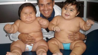 Charity Step in to Deal With Second Obese Colombian Baby