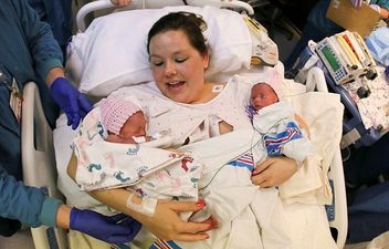 Rare “Mono Mono” Twin Girls Born Holding Hands