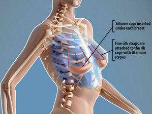 Is Beauty Really Skin Deep? Women Go Under the Knife for Under-The-Skin Bra