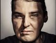 Shot-Gun Victim Who Had Face Transplant Models For GQ Magazine