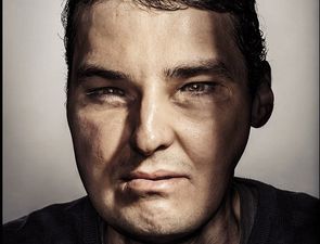 Shot-Gun Victim Who Had Face Transplant Models For GQ Magazine
