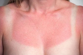 Her Check-Up: Treating Sunburn