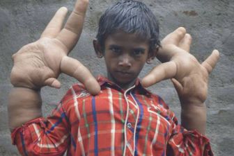 Boy Shunned From School After His Hands Grow Larger Than His Head