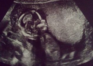 Irish Singer Announces Pregnancy on Instagram