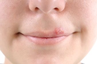 Having a Cold Sore Doubles The Risk of Alzheimer’s According to New Study