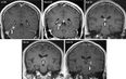 Doctors Discover Parasitic Tapeworm Living In Man’s Brain For Four Years