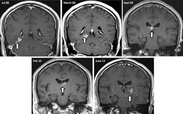 Doctors Discover Parasitic Tapeworm Living In Man’s Brain For Four Years