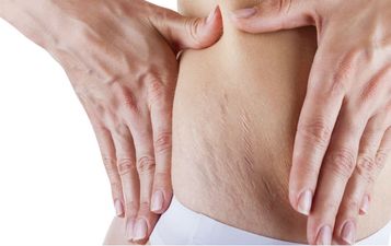 So This Is The Real Reason You Get Stretch Marks….