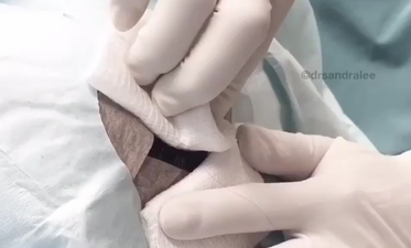 WATCH: A Cyst Was Popped On a Scalp And We’re Trying Not To Gag At Our Desks