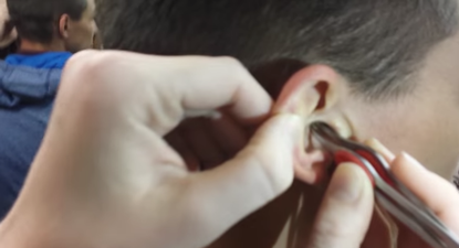 WATCH: A Man Had His Impacted Ear Wax Removed And Filmed… It Is DISGUSTING