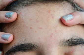 Research establishes a surprising fact for what causes acne