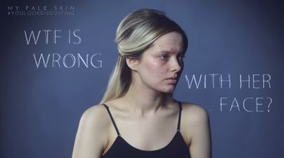 YouTube Vlogger Calls Out Acne Shamers With Powerful Video