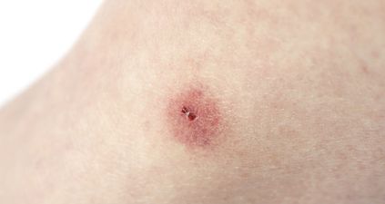 Her Check-Up: Treating An Insect Bite