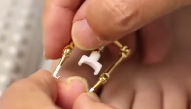 WATCH:  Ingrown Toenail? This Disgusting Video Shows How It Can Be Fixed…