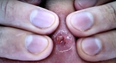 VIDEO: A 20-Year-Old Spot Being Popped is the Most Disgusting Thing You’ll Ever See