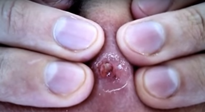 VIDEO: A 20-Year-Old Spot Being Popped is the Most Disgusting Thing You’ll Ever See