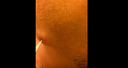 WATCH: Your Stomach Will Churn Watching This Man Popping His Own Tooth Infection