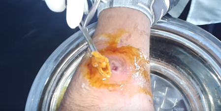 WATCH: A Man Had A Three Month Abscess On His Leg Popped On Camera…