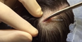 WATCH: The Dr.Pimple Popper Is Back And We Can’t Believe What She Pulled From Someone’s Scalp