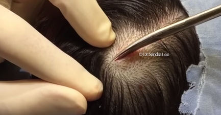 WATCH: The Dr.Pimple Popper Is Back And We Can’t Believe What She Pulled From Someone’s Scalp