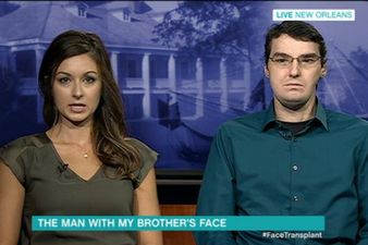 Woman Reveals Shock After Seeing Man With Late Brother’s Face Following Transplant