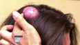 WATCH: Woman Gets Cyst The Size Of Egg Popped On Live TV