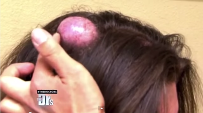 WATCH: Woman Gets Cyst The Size Of Egg Popped On Live TV