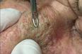 WATCH: The Disgusting Moment A Man Has Both His Pimples And Blackheads Popped At Once
