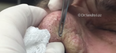 WATCH: This Incredibly Satisfying Blackhead Extraction