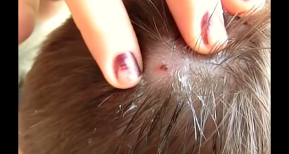 WATCH: A Botch Fly Maggot Being Pulled From A Man’s Scalp Will Make Your Stomach Hurl