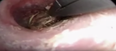 WATCH: The Moment A Woman Had A Spider And Its Web Removed From Her Ear