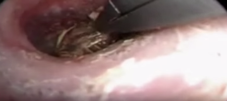 WATCH: The Moment A Woman Had A Spider And Its Web Removed From Her Ear
