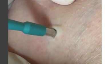 WATCH: You Won’t Believe What Was Pulled From The Cyst In This Woman’s Armpit…  