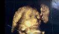 Ultrasound Reveals Ghost in This Woman’s Womb