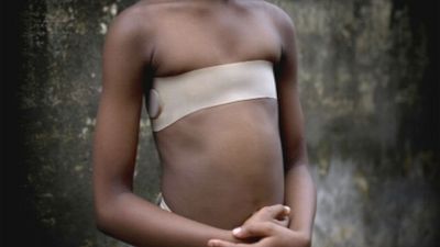 Horrendous Practice Of ‘Breast Ironing’ Taking Place In The UK