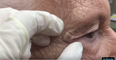 Dr. Pimple Popper Is Back… And Taking On a MASSIVE Blackhead
