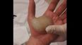 VIDEO: Man Gets MASSIVE Blister Popped