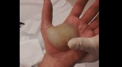 VIDEO: Man Gets MASSIVE Blister Popped