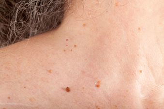 Here’s How You’re Developing Skin Tags (And How You Can Remove Them)