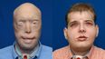 Disfigured Fireman Given New Lease of Life Following World’s Most Extensive Face Transplant
