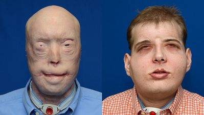 Disfigured Fireman Given New Lease of Life Following World’s Most Extensive Face Transplant