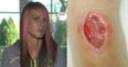 Woman Contracted Flesh Eating Bacteria From Wearing a Hair Tie on Her Wrist
